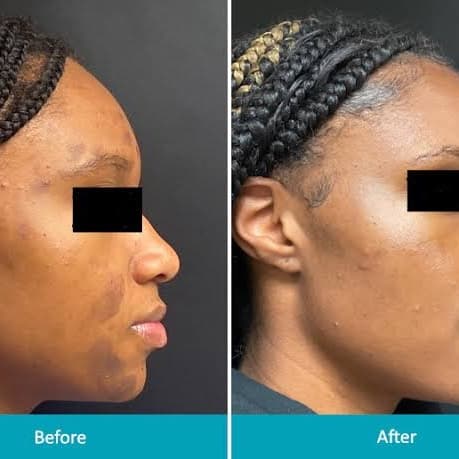 TCA PEEL SERIES ( 4 peel series) at Cam Cosmetics in Chicago, IL